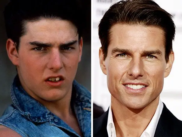 tom cruise teeth before and after